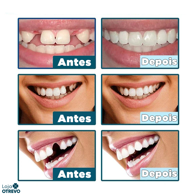 SmileFit - Facetas Dentárias Naturais Removíveis (Superior e Inferior)